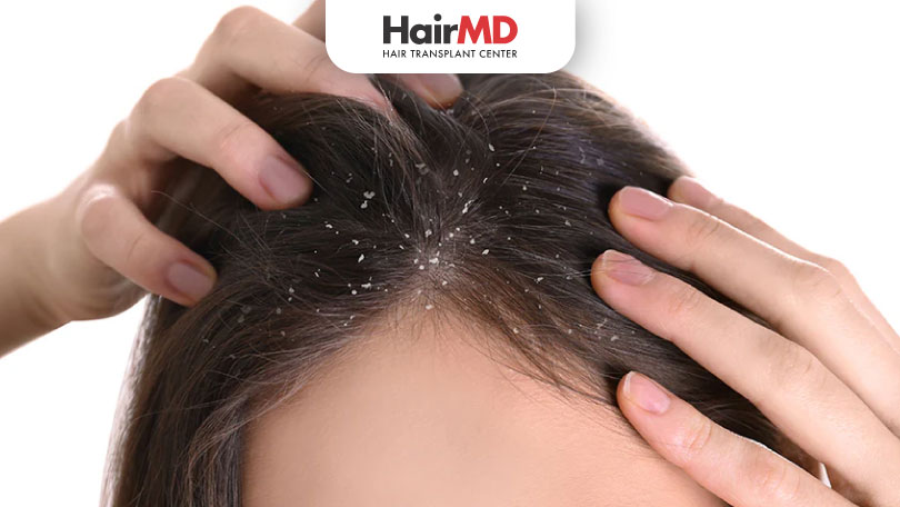 Effective Winter Dandruff Remedies & Treatments | HairMD India