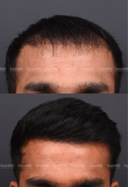 28-years old male Hair Transplant Results 1-Year 3000-4000 Grafts HairMD Pune