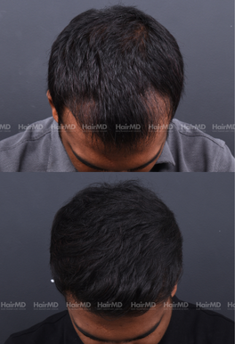 28-years old male Hair Transplant Results 1-Year 3000-4000 Grafts HairMD Pune