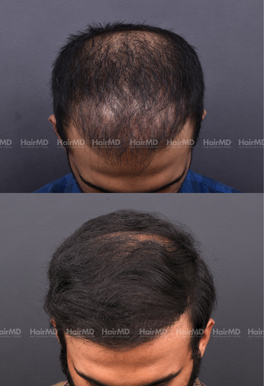 29-years old male Hair Transplant Results 1-Year 2000-3000 Grafts HairMD Pune