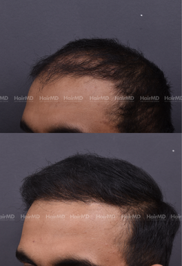 29-years old male Hair Transplant Results 1-Year 2000-3000 Grafts HairMD Pune