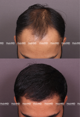 32-years old male Hair Transplant Results 1.5-Year 3000-4000 Grafts HairMD Pune