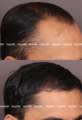 32-years old male Hair Transplant Results 1.5-Year 3000-4000 Grafts HairMD Pune