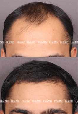 32-years old male Hair Transplant Results 1.5-Year 3000-4000 Grafts HairMD Pune