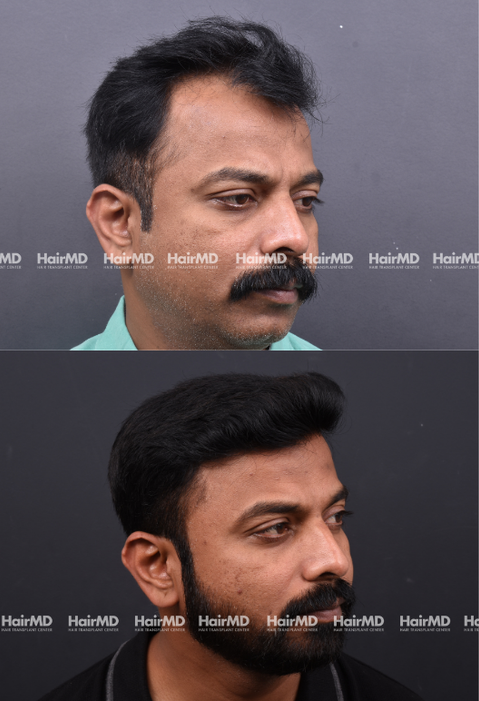 35-year old male Hair Transplant Results 2-Years 4000-5000 Grafts HairMD Pune