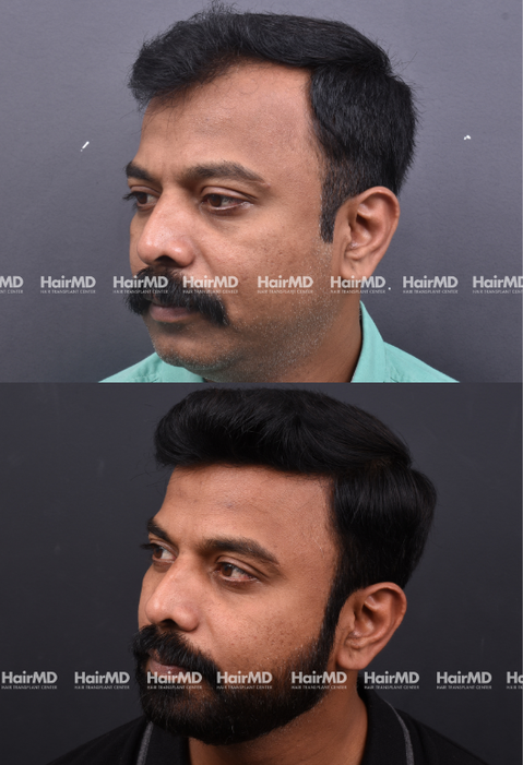 35-year old male Hair Transplant Results 2-Years 4000-5000 Grafts HairMD Pune