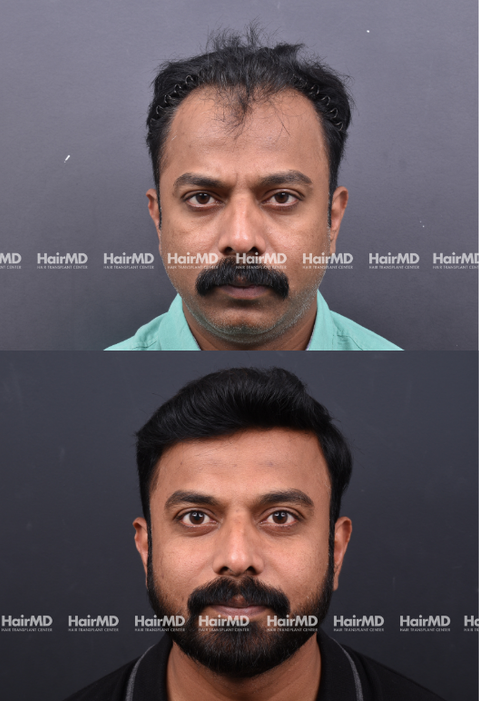 35-year old male Hair Transplant Results 2-Years 4000-5000 Grafts HairMD Pune