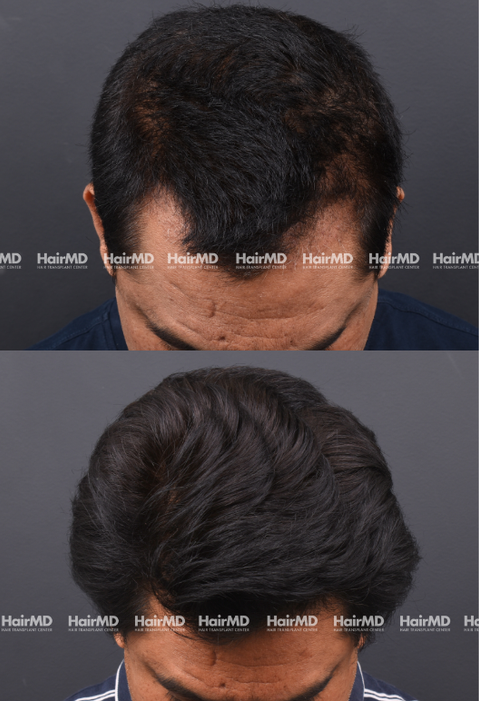 37-years old male Hair Transplant Results 1-Year 3000-4000 Grafts HairMD Pune