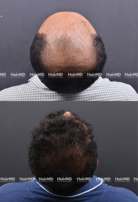 38-year old male Hair Transplant Results 2-Years 4000-5000 Grafts HairMD Pune