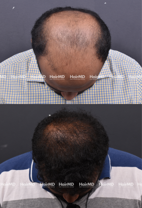 38-year old male Hair Transplant Results 2-Years 4000-5000 Grafts HairMD Pune