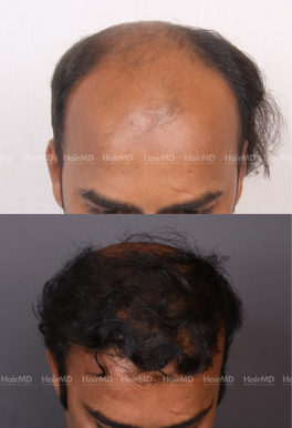 38-years old male Hair Transplant Results 2-Year 4000-5000 Grafts HairMD Pune