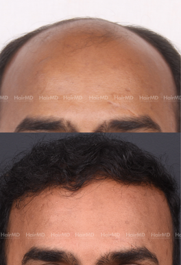 38-years old male Hair Transplant Results 2-Year 4000-5000 Grafts HairMD Pune