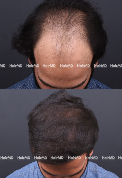 40-year old male Hair Transplant Results 2-Year 4000-5000 Grafts HairMD Pune