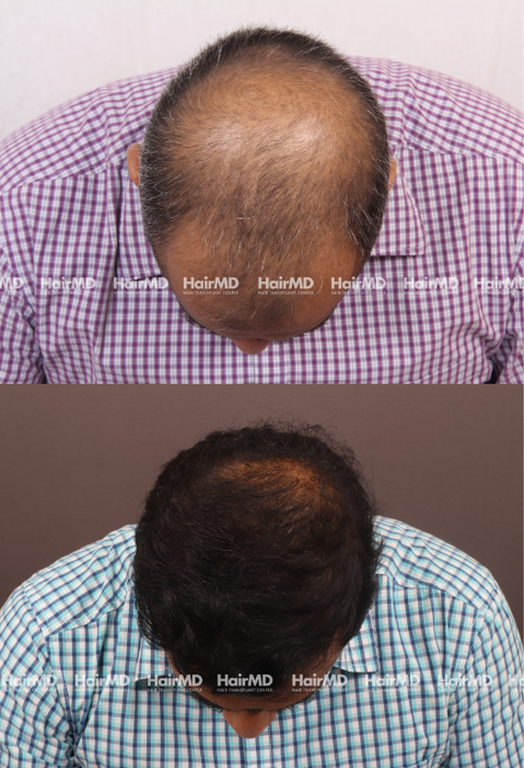 40-year old male Hair Transplant Results 2-Years 4000-5000 Grafts HairMD Pune