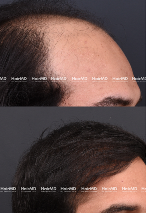 40-year old male Hair Transplant Results 2-Year 4000-5000 Grafts HairMD Pune