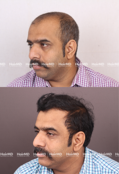 40-year old male Hair Transplant Results 2-Years 4000-5000 Grafts HairMD Pune