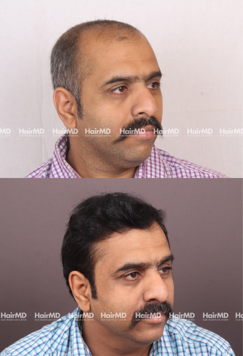 40-year old male Hair Transplant Results 2-Years 4000-5000 Grafts HairMD Pune