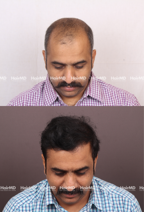 40-year old male Hair Transplant Results 2-Years 4000-5000 Grafts HairMD Pune
