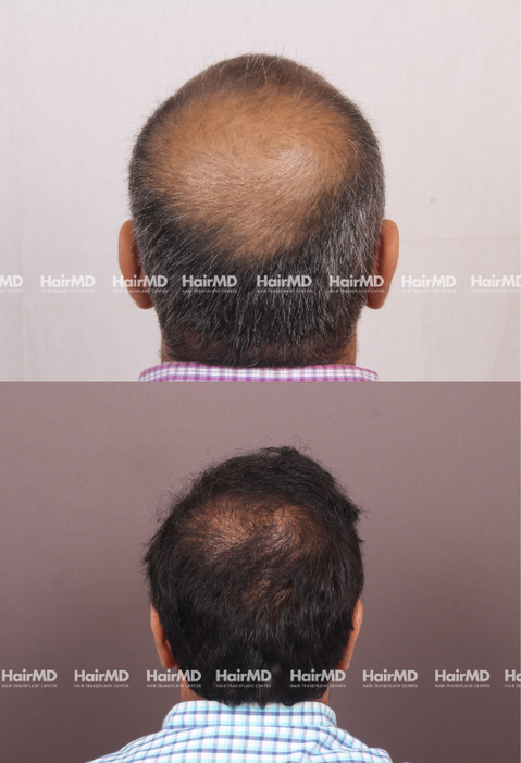 40-year old male Hair Transplant Results 2-Years 4000-5000 Grafts HairMD Pune