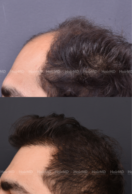 40-years old male Hair Transplant Results 2-Year 4000-5000 Grafts HairMD Pune