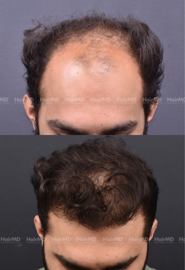 40-years old male Hair Transplant Results 2-Year 4000-5000 Grafts HairMD Pune