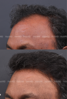 41-years old male Hair Transplant Results 1-Year 2000-3000 Grafts HairMD Pune