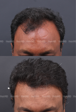 41-years old male Hair Transplant Results 1-Year 2000-3000 Grafts HairMD Pune