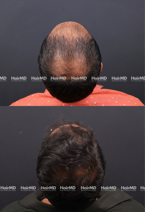 42-year old male Hair Transplant Results 2-Year 4000-5000 Grafts HairMD Pune