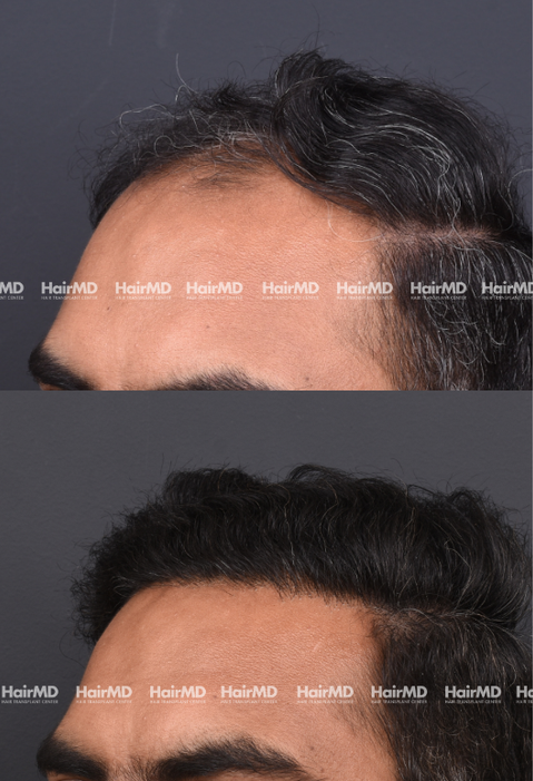 42-year old male Hair Transplant Results 2-Year 4000-5000 Grafts HairMD Pune