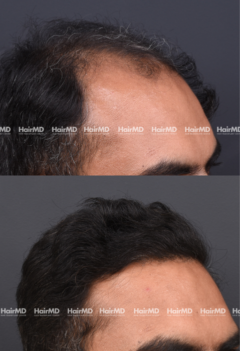 42-year old male Hair Transplant Results 2-Year 4000-5000 Grafts HairMD Pune