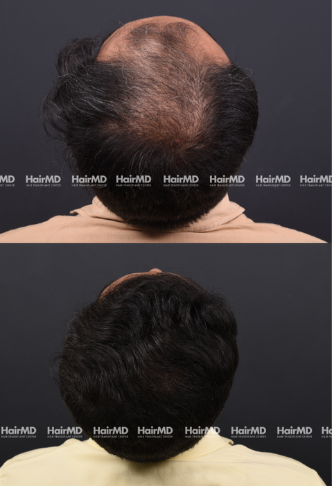 42-year old male Hair Transplant Results 2-Year 4000-5000 Grafts HairMD Pune