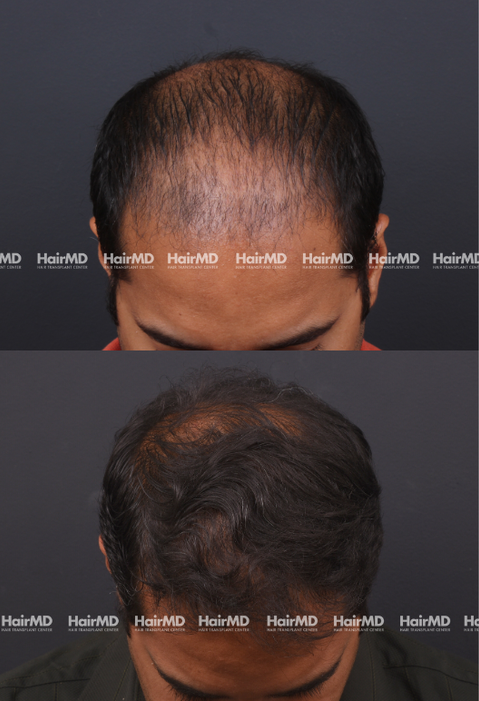 42-year old male Hair Transplant Results 2-Year 4000-5000 Grafts HairMD Pune