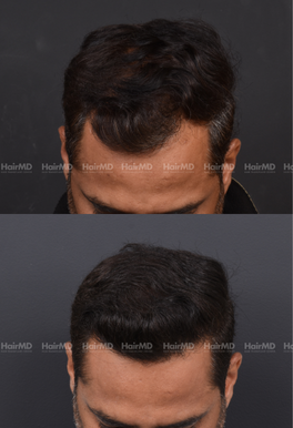 42-years old male Hair Transplant Results 1-Year 3000-4000 Grafts HairMD Pune