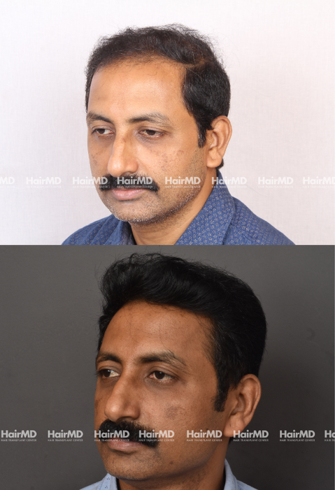 43 year old male Hair Transplant Results 2-Years 4000-5000 Grafts HairMD Pune