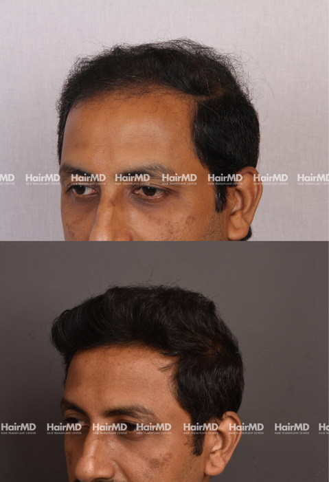 Uday Warke Hair Transplant Results 2 Years 4000-5000 Grafts HairMD Pune