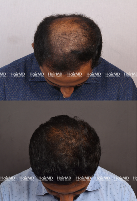 Uday Warke Hair Transplant Results 2 Years 4000-5000 Grafts HairMD Pune