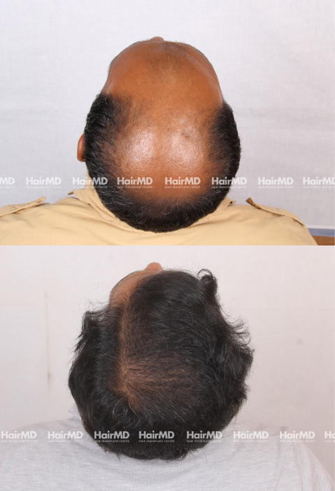 43-year old male Hair Transplant Results 2-Years 5000-6000 Grafts HairMD Pune