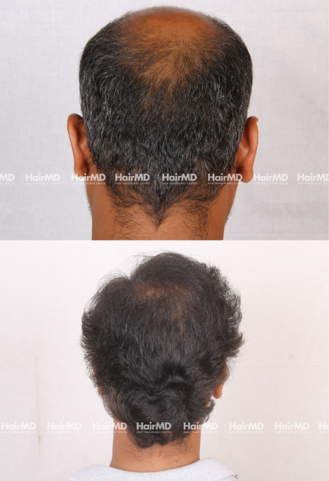 43-year old male Hair Transplant Results 2-Years 5000-6000 Grafts HairMD Pune