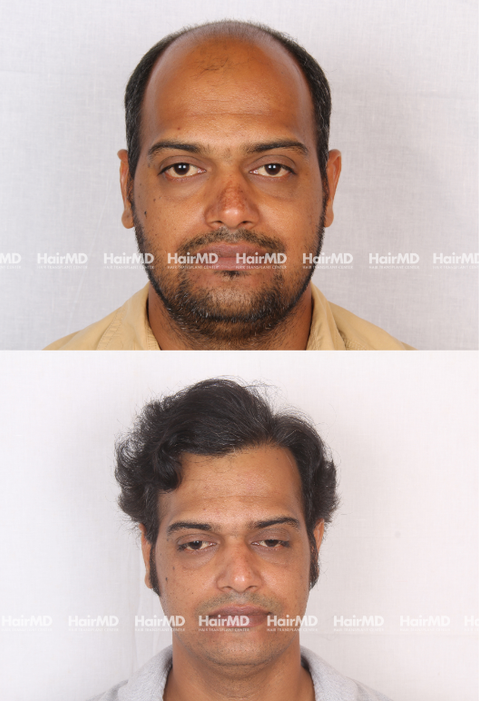 43-year old male Hair Transplant Results 2-Years 5000-6000 Grafts HairMD Pune