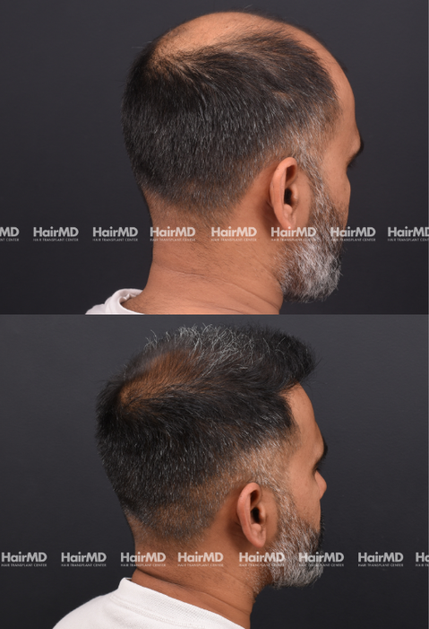 45-year old male Hair Transplant Results 2-Years 4000-5000 Grafts HairMD Pune