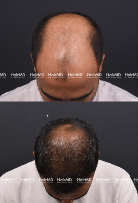 45-year old male Hair Transplant Results 2-Years 4000-5000 Grafts HairMD Pune