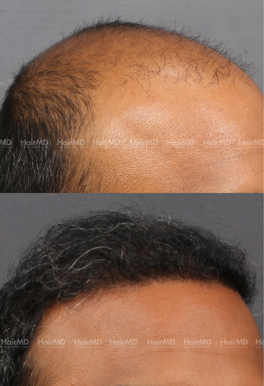 45-years old male Hair Transplant Results 2-Year 4000-5000 Grafts HairMD Pune