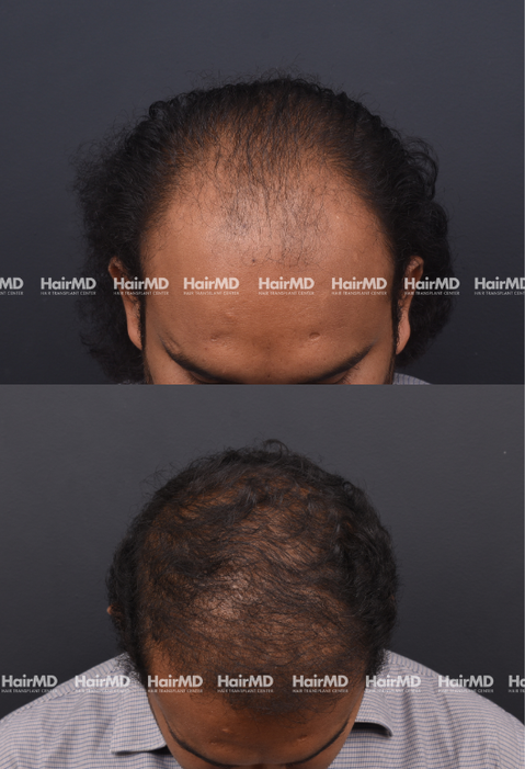 46-year old male Hair Transplant Results 2-Year 4000-5000 Grafts HairMD Pune