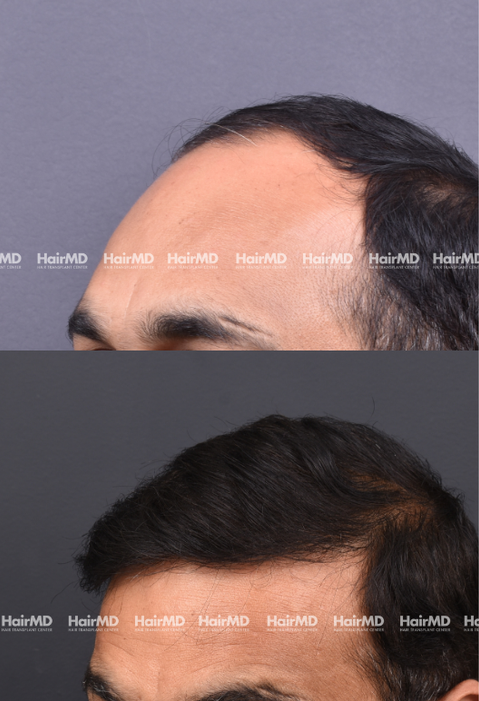 47-year old male Hair Transplant Results 1-Year 3000-4000 Grafts HairMD Pune