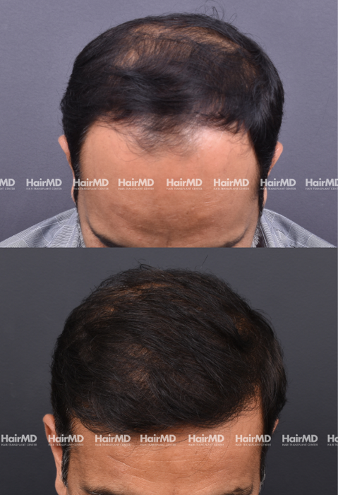 47-year old male Hair Transplant Results 1-Year 3000-4000 Grafts HairMD Pune