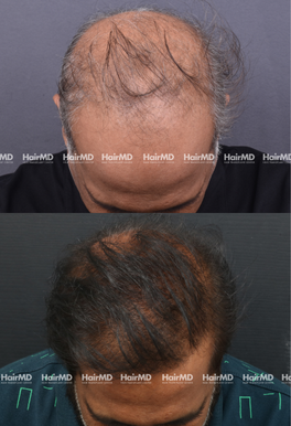 52-years old male Hair Transplant Results 1.5-Year 5000-6000 Grafts HairMD Pune