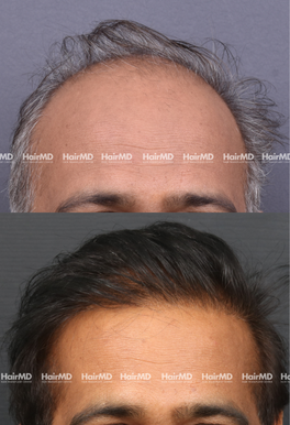 52-years old male Hair Transplant Results 1.5-Year 5000-6000 Grafts HairMD Pune