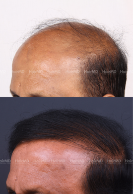 56-years old male Hair Transplant Results 2-Year 5000-6000 Grafts HairMD Pune