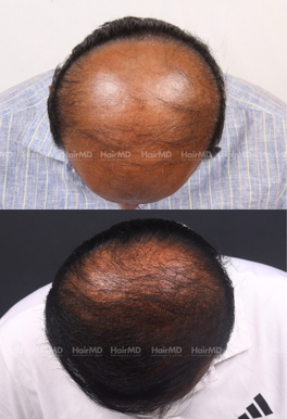 56-years old male Hair Transplant Results 2-Year 5000-6000 Grafts HairMD Pune