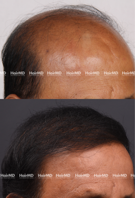 56-years old male Hair Transplant Results 2-Year 5000-6000 Grafts HairMD Pune